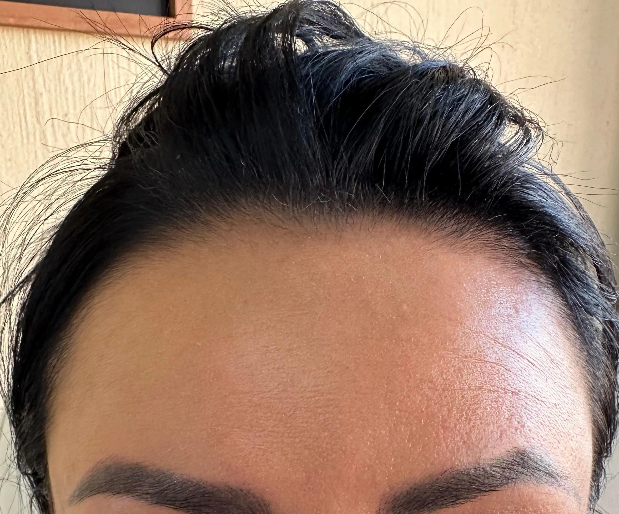 Toxina Botulínica - Después